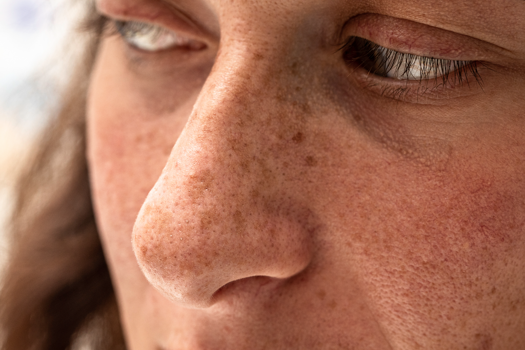 CAN FERMENTED FOODS REDUCE DARK SPOTS AND HYPERPIGMENTATION?